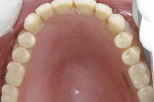 Achieve Superior Dental Restorations with Eurasia Dental Lab's Zirconia Restorations 