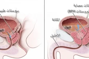 هل يمكن أن تظهر أعراض التهاب البروستاتا فجأة