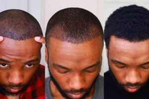 Best Hair Transplat Turkey (2)